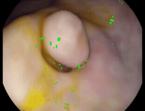 Specular Reflection Removal